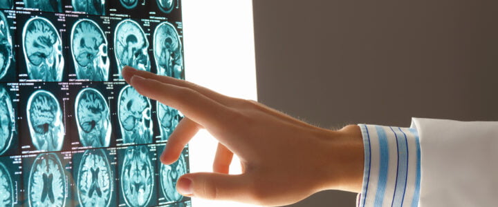 Brain injury may accelerate onset of neurodegenerative disease by up to five years, study reveals